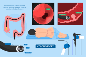 diagram for a colonoscopy