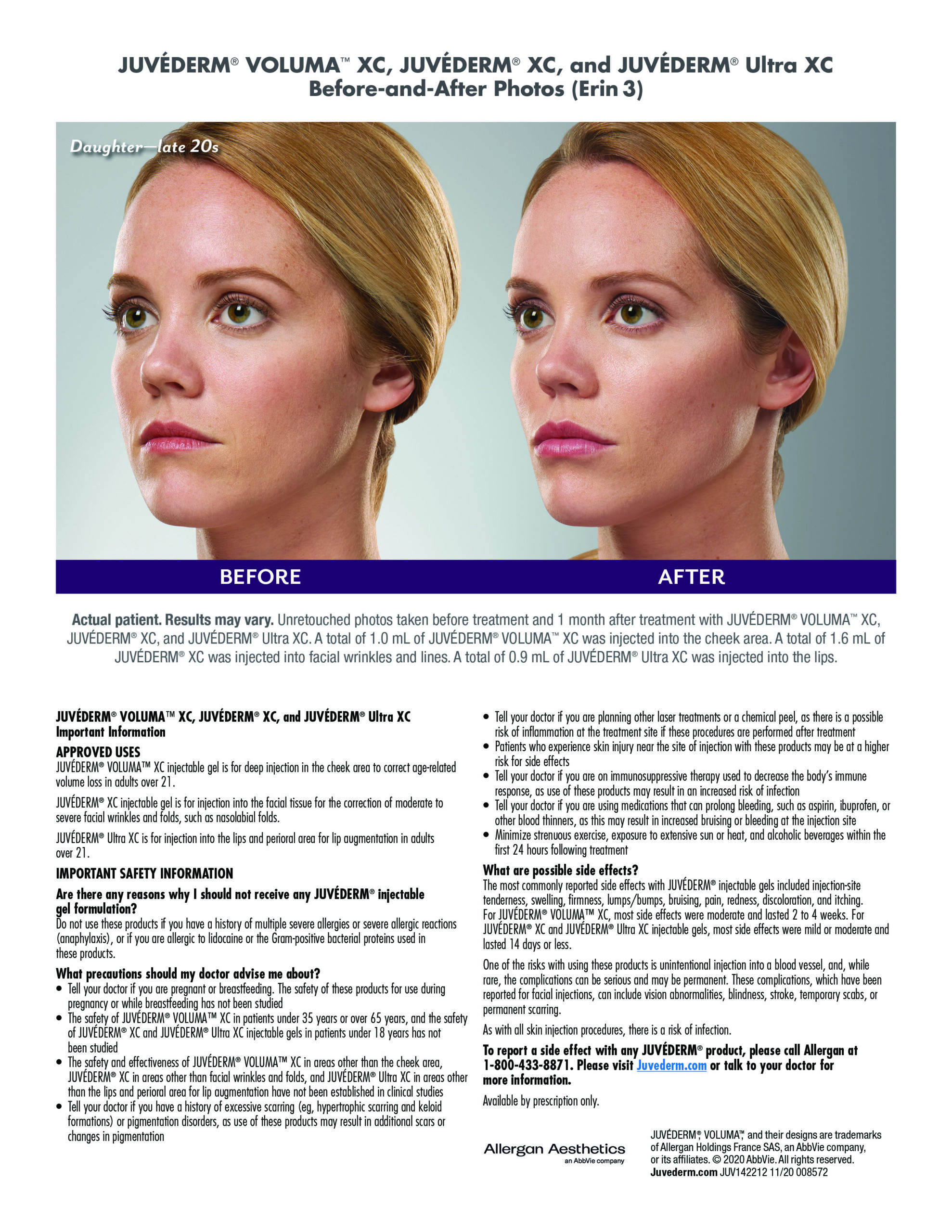 Juvederm before and after